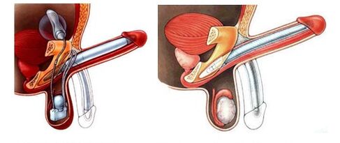 Penile prosthesis with inflatable (left) and plastic (right) prostheses