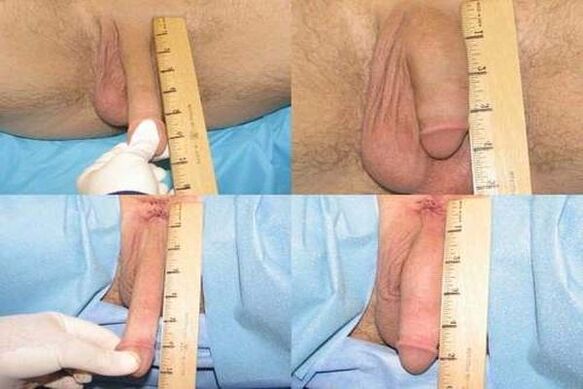 Penis measurement after enlargement surgery.
