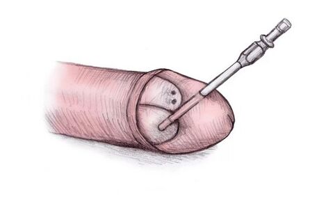 The head of the penis can be enlarged by injecting hyaluronic gel.