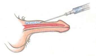Hyaluronic Acid Volumizing Injection Into The Penis